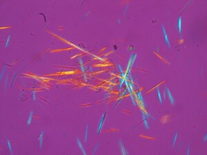 Harnsäurekristalle aus der Gelenksflüssigkeit eines Gichtpatienten (Aufnahme mit polarisiertem Licht)