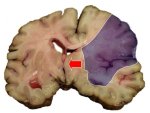 Hirngewebe nach Schlaganfall (betroffene Hirnregion blau markiert)