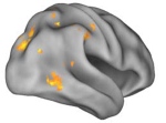 Die gelben und orangen Bereiche des fMRT-Scans von Menschen mit Alzheimer-Plaques markieren Hirnregionen, die bei detaillierter Erinnerung verstärkt aktiv sind.