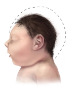Vergleich der Kopfgrößen eines Babys mit Mikrozephalie (links) und eines gesunden Kindes.