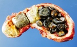 Geöffnete Gallenblase mit zahlreichen Gallensteinen