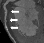 Vergleichende Aufnahmen mit Hilfe der koronaren CT-Angiographie bei einem Patienten ohne Alkoholkonsum (obere Reihe) und einem Patienten mit mäßigem Alkoholkonsum (untere Reihe) zeigen ähnlich starke Ablagerungen (Pfeile).