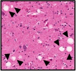 Im Vergleich zu unbehandelten Ratten (links) zeigt das Hirngewebe der behandelten Tiere (rechts) weniger „Löcher“ (Pfeile), die abgestorbene Neuronen hinterlassen haben.