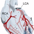 Herzinfarkt der Vorderwandspitze (2) nach Verschluss (1) der linken Kranzarterie (LCA)