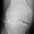 Röntgenbild einer Kniegelenksarthrose (Gonarthrose)