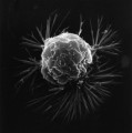 Brustkrebszelle im Rasterelektronenmikroskop