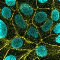 Brustkrebszellen bilden große Mengen an Nectin-4 (gelb), Zellkerne sind blau gefärbt.