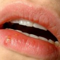Durch Herpes-simplex-Viren vom Typ 1 ausgelöster Lippenherpes (Herpes labialis)
