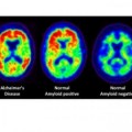 PET-Scans zeigen die typischen Amyloid-Ablagerungen im Gehirn