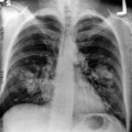 Röntgenaufnahme der Brust: Verdacht auf Lungenkrebs