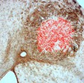 In das Gehirn einer Maus injizierte Tumorzellen (rot) sind nach 14 Tagen von zahlreichen Stamm- und Vorläuferzellen (braun) umgeben.