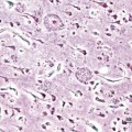 Sogenannte Senile Plaques sind Ablagerungen von Beta-Amyloid im Gehirn. 