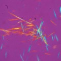 Harnsäurekristalle aus der Gelenksflüssigkeit eines Patienten, fotografiert im polarisierten Licht