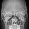 Das Röntgenbild des menschlichen Schädels zeigt die Nasennebenhöhlen.