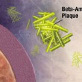 Schematische Darstellung von Beta-Amyloid-Plaques