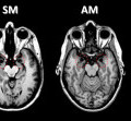 Kernspinaufnahmen zeigen die geschädigte Amygdala der Patientinnen „SM“, „AM“ und „BG“ im Vergleich zum gesunden Gehirn