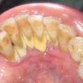 Im Zahnstein sind Mundbakterien eingeschlossen, deren DNA sich noch nach Jahrtausenden nachweisen lässt.