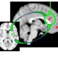 Kooperation für ein gesundes Selbstbewusstsein: Über bildgebende Verfahren wird die Interaktion zwischen Striatum (links) und Stirnlappen (rechts) sichtbar