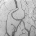 Feinste Blutgefäße, dargestellt mit einer speziellen Technik der Dunkelfeldmikroskopie (Sidestream Dark Field Imaging)