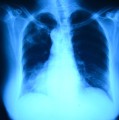 Röntgenaufnahme der Lungen eines Tuberkulosepatienten.