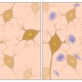 Bei der Alzheimer-Demenz bilden sich unter anderem Ablagerungen von Beta-Amyloid (blau) zwischen den Nervenzellen.