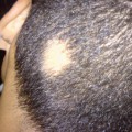 Kreisrunder Haarausfall (Alopecia areata) im Anfangsstadium