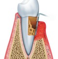 Bei einer Parodontitis bilden sich tiefe Zahnfleischtaschen, in denen sich die Krankheitserreger vermehren.
