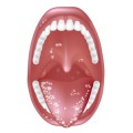 Weiße Beläge auf Zunge und Mundschleimhaut sind Merkmale von Soor, einer Form der Kandidose.
