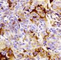 Eine spezielle Färbung macht Krebszellen mit Integrin-beta3 (braun) sichtbar.