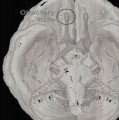 Der Riechkolben (eingekreiste Struktur im Hirnscan) leitet Geruchsinformationen von der Nase zum Gehirn.