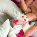 Eine mikroskopische Untersuchung von Blutausstrichen ist die einfachste Methode der Malariadiagnose.