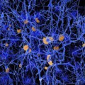 Beta-Amyloid-Ablagerungen (orange) zwischen den Hirnzellen sind ein typisches Merkmal der Alzheimer-Demenz.
