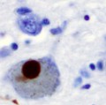 Ablagerung von Alpha-Synuklein (braun) in einer Hirnzelle bei Parkinson.