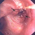Bronchoskopisches Bild eines Bronchialkarzinoms (Pfeile), das den linken Oberlappenbronchus bereits leicht einengt