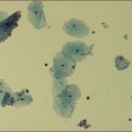Gardnerella vaginalis mit Epithelzellen eines Vaginalabstrichs (gefärbt)