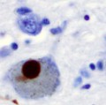 Bei der Parkinson-Erkrankung lagern sich Partikel aus Alpha-Synuclein (dunkelbraun gefärbt) in Neuronen der Substantia nigra, einem Teil des Mittelhirns, ab.