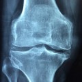Das Kniegelenk ist besonders häufig von Arthrose betroffen.