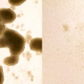 Stammzellen eines Hirntumors vor (links) und nach (rechts) einer Zika-Virus-Infektion