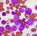 Blutbild bei chronisch myeloischer Leukämie (CML) mit erhöhter Zahl weißer Blutkörperchen