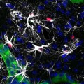 Zellen von Krebsmetastasen (grün) im Gehirn aktivieren den Stat3-Signalweg (rot) in reaktiven Astrozyten (weiß).