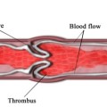 Schematische Darstellung eines Thrombus (Blutgerinnsel)