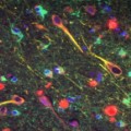 Gingipaine (rot) von Porphyromonas gingivalis in Neuronen (gelb) eines Gehirns mit Alzheimer-Erkrankung