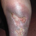 Chronische Wunden wie das offene Bein (Ulcus cruris) sind häufig mit Pseudomonaden infiziert, die Bakteriophagen freisetzen.