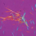 Harnsäurekristalle aus der Gelenksflüssigkeit eines Gichtpatienten (Aufnahme mit polarisiertem Licht)