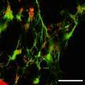 Neutrophile extrazelluläre Fallen (NETs) im Gallengries (DNA grün gefärbt)