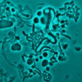 E.coli-Bakterien wandeln sich von der natürlichen Stäbchenform in kugelige und unregelmäßig geformte zellwandlose L-Formen um.