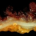 Längsschnitt durch die Dickdarmwand bei Colitis ulcerosa (entzündete Schleimhaut rot gefärbt)