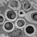 In chronisch entzündeten Bereichen der Darmschleimhaut von Morbus-Crohn-Patienten lassen sich Debaryomyces hansenii-Hefen nachweisen, die den Heilungsprozess hemmen.