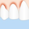 Schematische Darstellung einer Zahnfleischentzündung (Gingivitis)